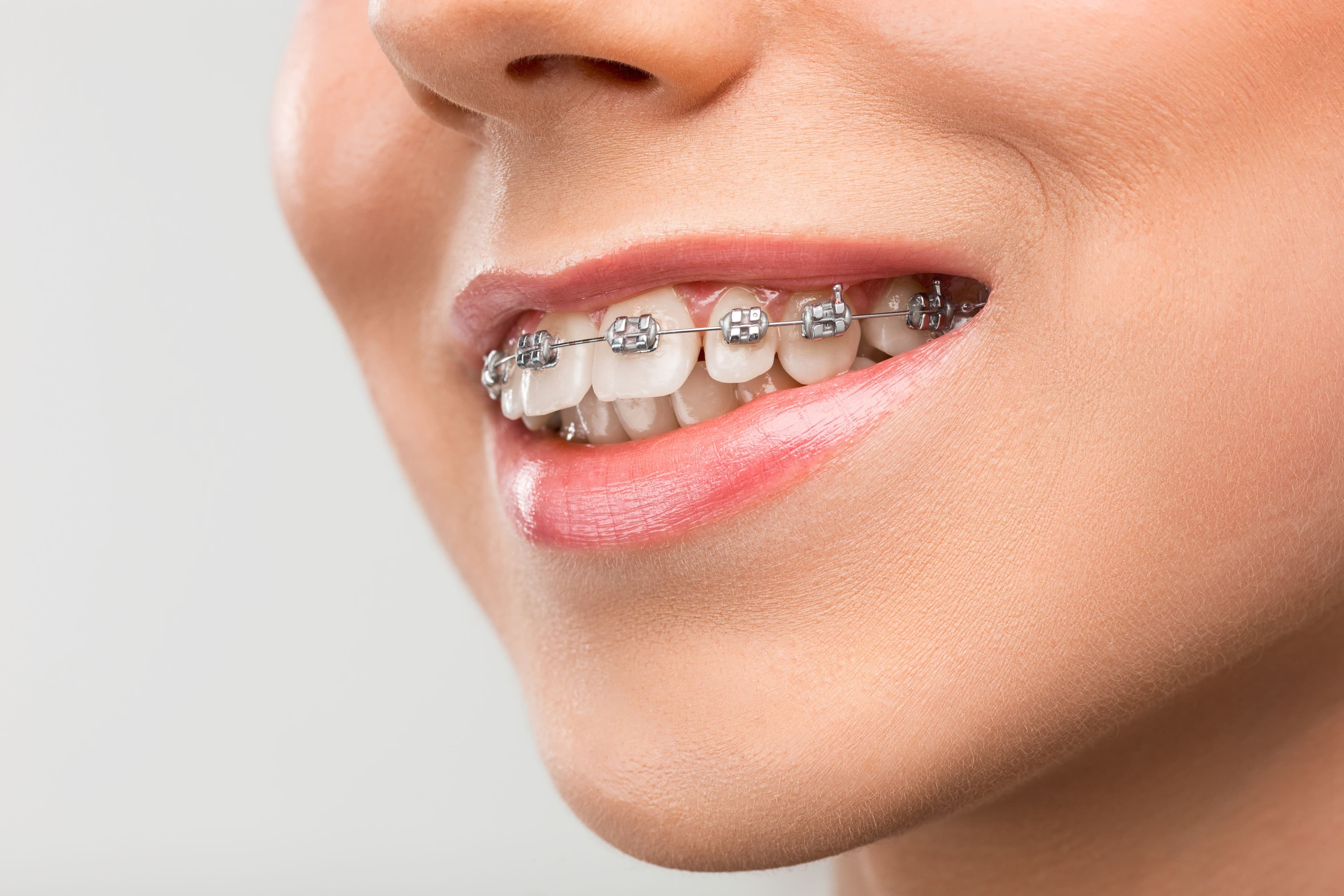 Braces Treatment
