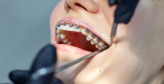 Crooked teeth treatment