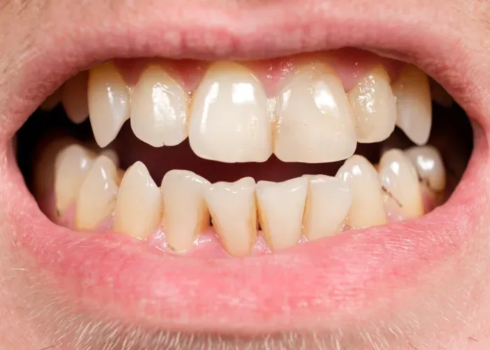 Gum recession