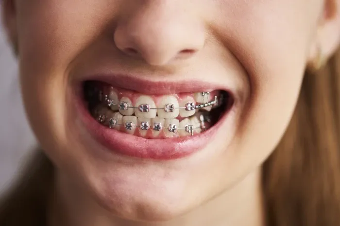 How to care for braces.webp