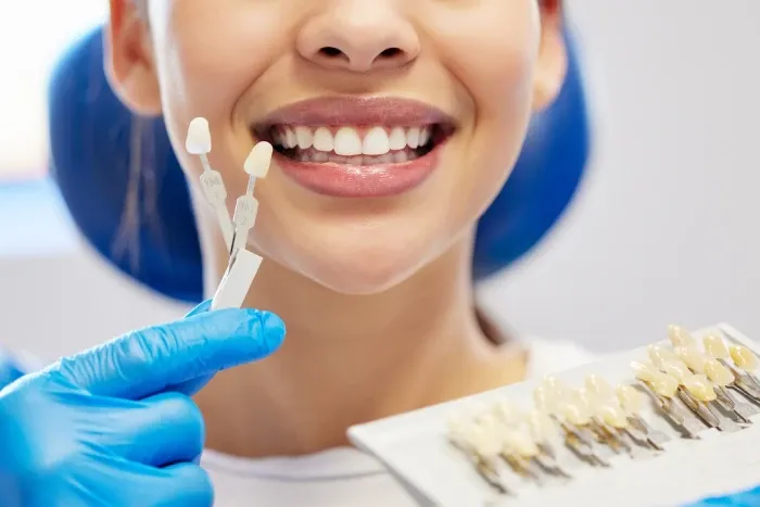 Laminate Dental Veneer.webp