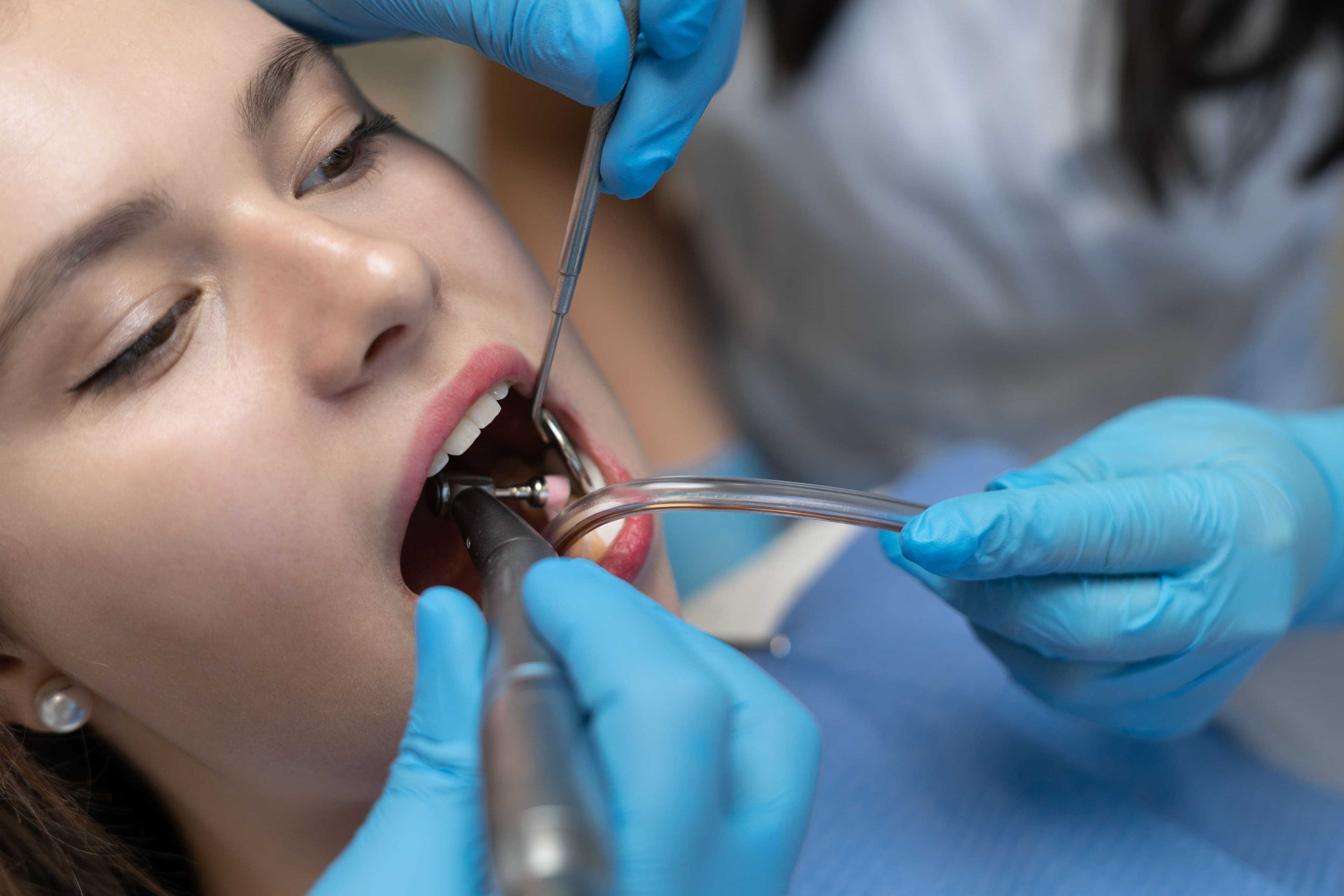 Tooth Filling