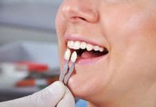 What is Tooth Bonding?
