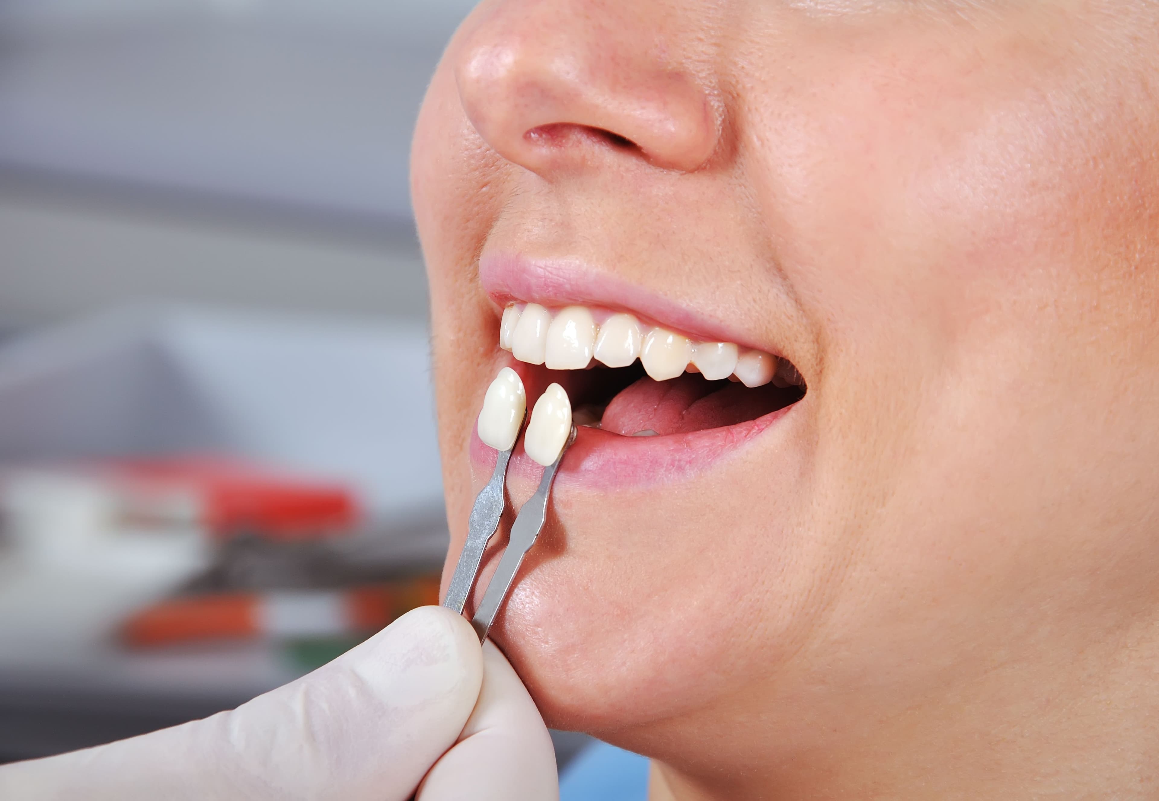What is Tooth Bonding?