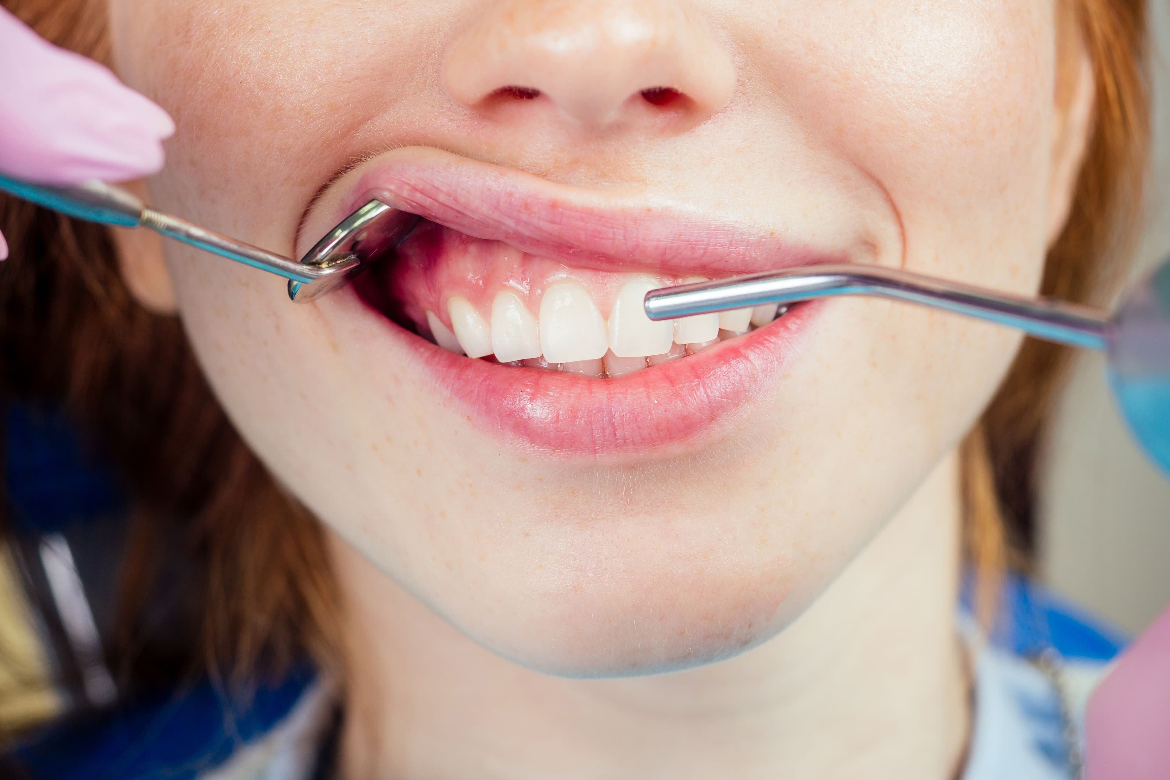 periodontoloji-fiyatlari-distedavim