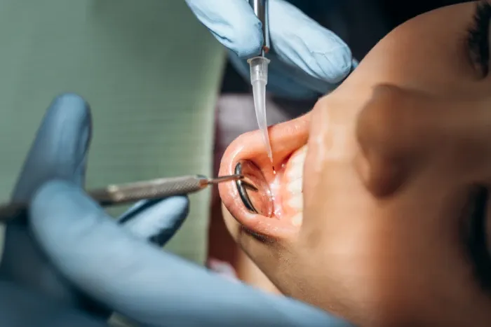 tooth abscess.webp