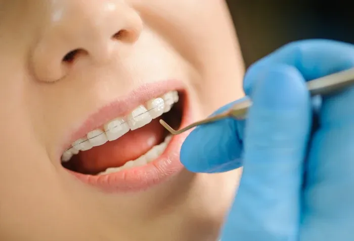 what is braces wax