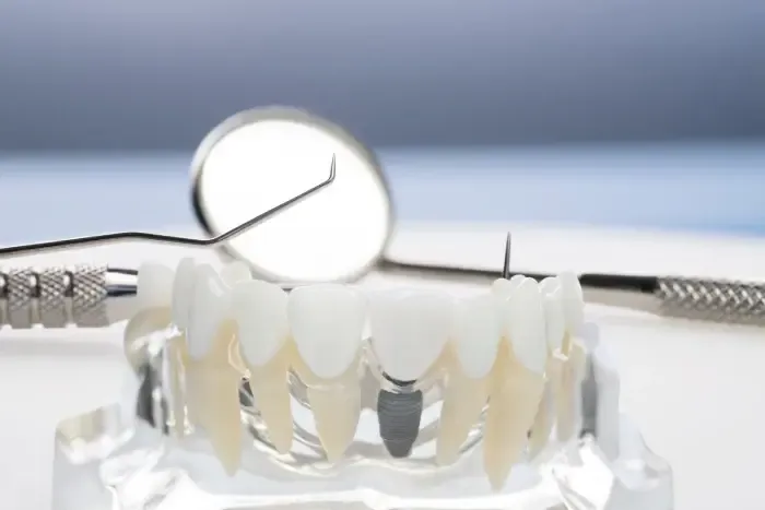 zigoma implant nedir.webp