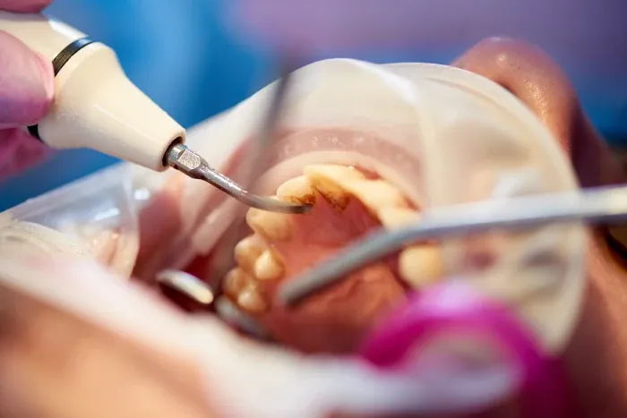 Causes of Tooth Decay Precautions You Should Take for Healthy Teeth.webp