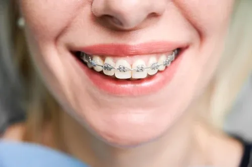Removable Orthodontic Treatment